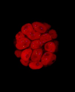 Imagen de un tumor canceroso en los conductos galactóforos de una mama humana.